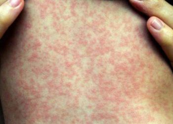 Espírito Santo confirma primeiro caso importado de sarampo