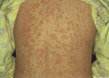 Sobe para 16 o número de estados brasileiros com casos confirmados de sarampo