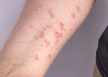 A Secretaria Municipal de Saúde de Nova Venécia através da Vigilância Epidemiológica confirma o primeiro caso de Monkeypox no município