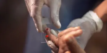 SUS começa a usar novo tratamento contra a malária em crianças